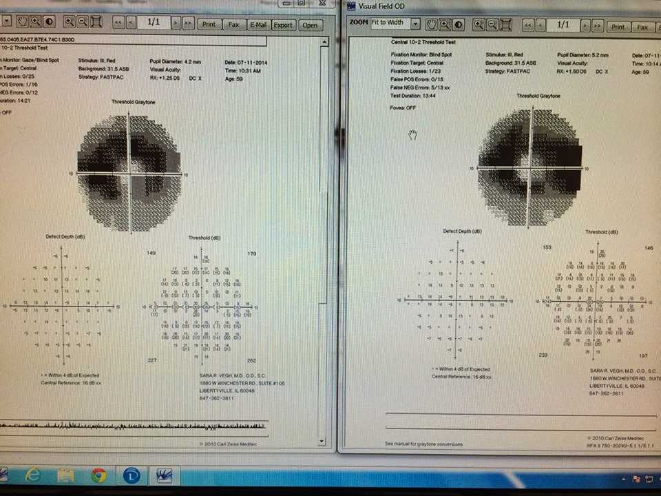 plaquenil eye exam frequency