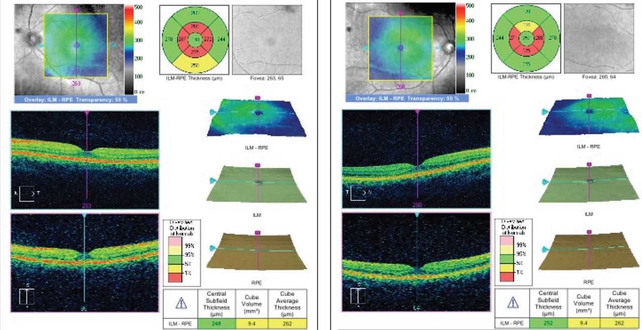 plaquenil eye exam frequency