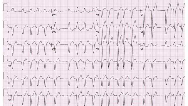 ecg academy level 1 final exam answers