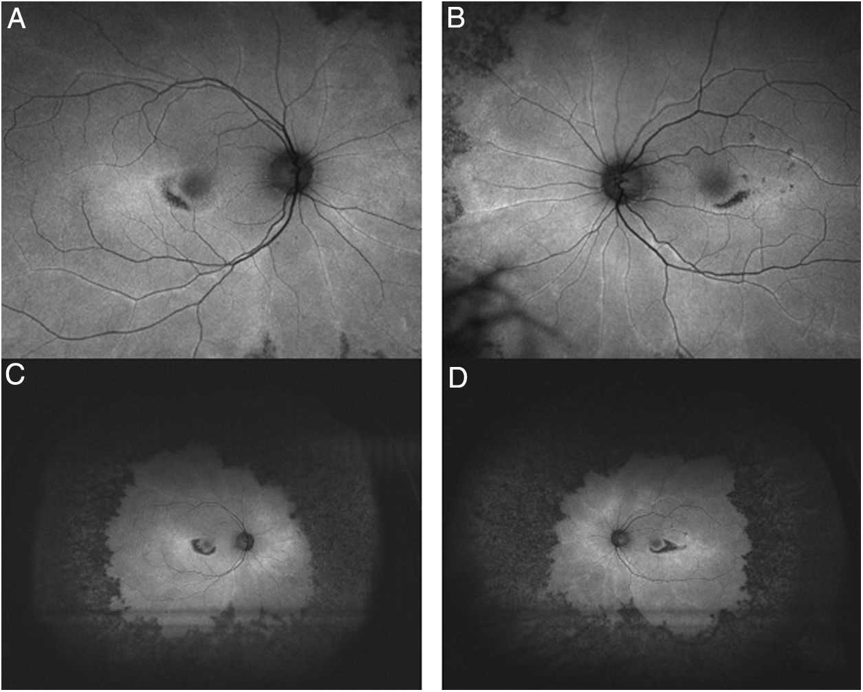 plaquenil eye exam frequency